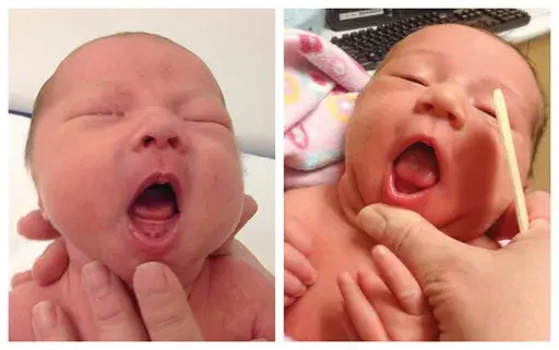 This combination of photos provided by Dr. Maya Bunik in July 2024, shows a baby with ankyloglossia where the tongue does not extend beyond the gums, left, and a baby with an indentation at the tip of a the tongue which may be a sign of ankyloglossia. On Monday, July 29, 2024, one of the largest doctor's groups in the U.S., voiced concerns that the condition, also known as "tongue-tie" which can affect breastfeeding, is being over-diagnosed and often treated with unnecessary surgery to babies' m
