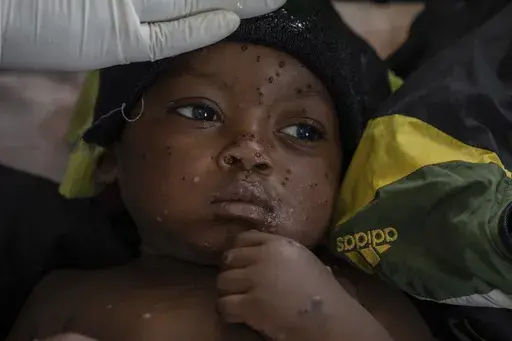 2 year old Emile Miango, who has mpox, lies in a hospital, in Kamituga, South Kivu province, Sept. 4, 2024, which is the epicenter of the world's latest outbreak of the disease in eastern Congo. (AP Photo/Moses Sawasawa, file)