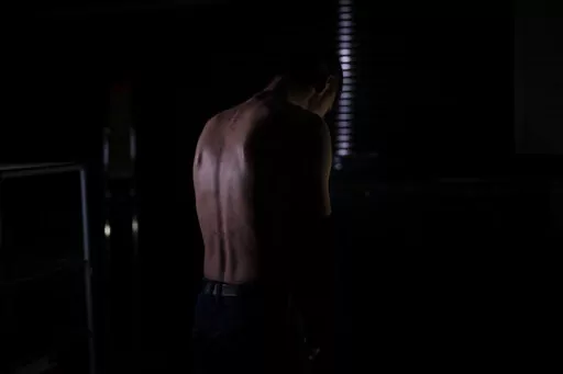 In this Nov. 23, 2022 photo, Igor shows the remains of marks on his back after allegedly being tortured by Russian forces in Kherson. The 22-year-old, accused of providing Ukrainians with Russia's military positions, was stung with a taser along his back for two and half hours and then forced to stay awake, seated in a chair all night. He was freed after two days but not before writing a letter providing details about a relative of his uncle's who the Russians wanted information on. (AP Photo/Be